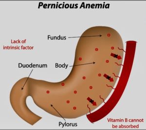 pernicious anemia