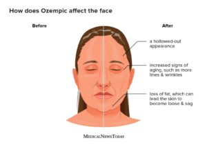 Ozempic Face